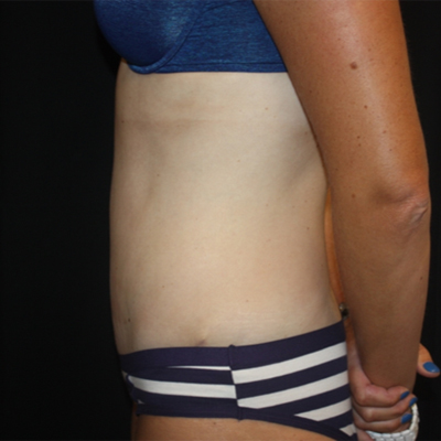 Tummy Tuck Before & After Patient #22609