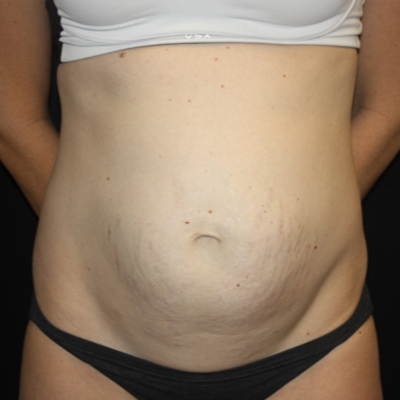 Tummy Tuck Before & After Patient #22609