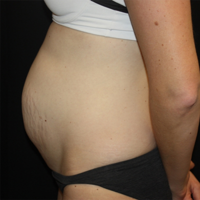 Tummy Tuck Before & After Patient #22609