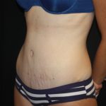 Tummy Tuck Before & After Patient #22609