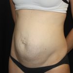 Tummy Tuck Before & After Patient #22609