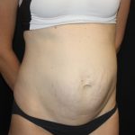 Tummy Tuck Before & After Patient #22609