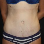 Tummy Tuck Before & After Patient #22609