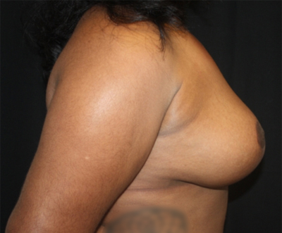 Breast Reduction Before & After Patient #23696
