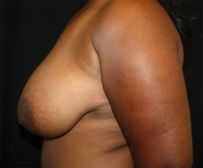 Breast Reduction Before & After Patient #23696