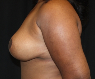 Breast Reduction Before & After Patient #23696