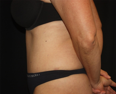 Tummy Tuck Before & After Patient #19909