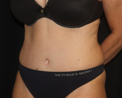 Tummy Tuck Before & After Patient #19909