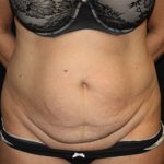 Tummy Tuck Before & After Patient #19909