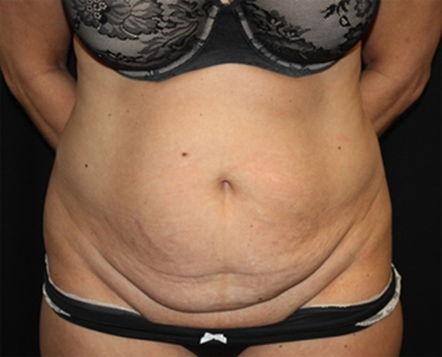 Tummy Tuck Before & After Patient #19909