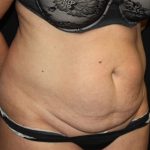 Tummy Tuck Before & After Patient #19909