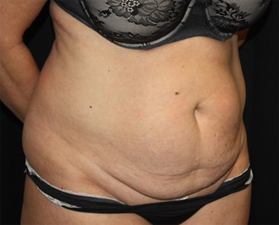 Tummy Tuck Before & After Patient #19909