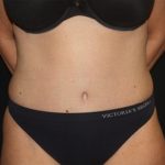 Tummy Tuck Before & After Patient #19909