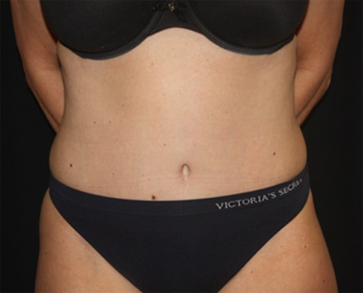 Tummy Tuck Before & After Patient #19909