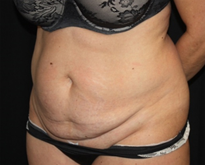 Tummy Tuck Before & After Patient #19909