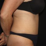 Tummy Tuck Before & After Patient #19909