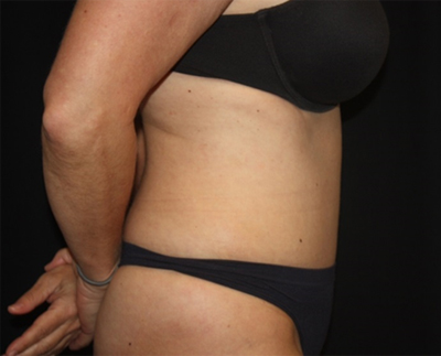Tummy Tuck Before & After Patient #19909
