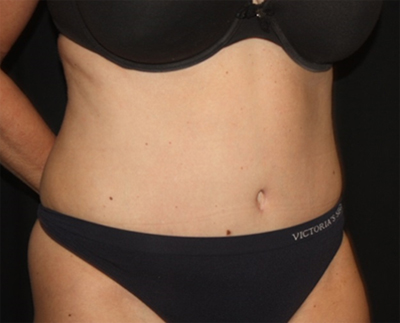 Tummy Tuck Before & After Patient #19909