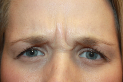 Botox and Dysport Before & After Patient #24707