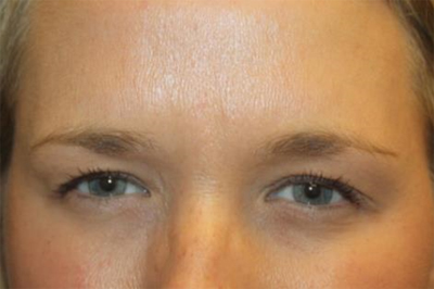 Botox and Dysport Before & After Patient #24707