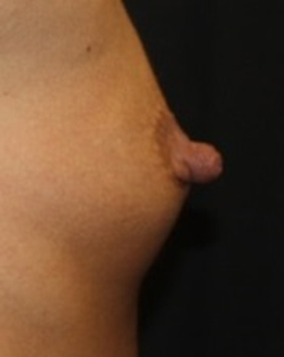 Nipple Revision Before & After Patient #20851