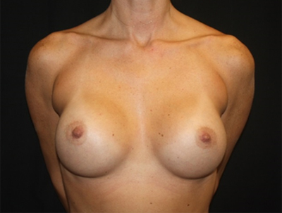 Nipple Revision Before & After Patient #20851