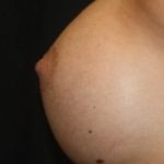 Nipple Revision Before & After Patient #20851