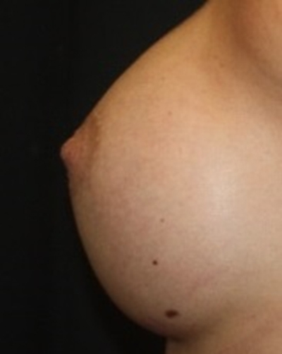 Nipple Revision Before & After Patient #20851