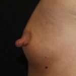 Nipple Revision Before & After Patient #20851