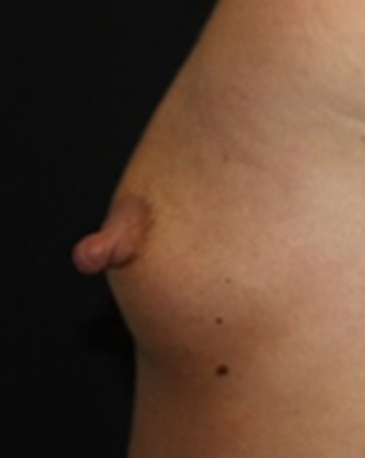 Nipple Revision Before & After Patient #20851