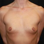 Nipple Revision Before & After Patient #20851