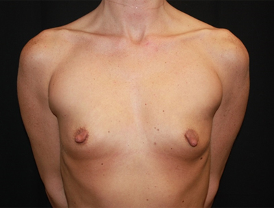 Nipple Revision Before & After Patient #20851