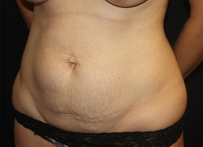 Tummy Tuck Before & After Patient #19963