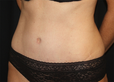 Tummy Tuck Before & After Patient #19963