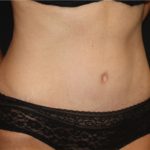 Tummy Tuck Before & After Patient #19963