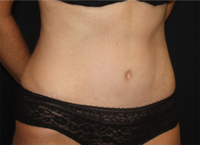 Tummy Tuck Before & After Patient #19963