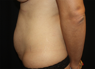 Tummy Tuck Before & After Patient #19963