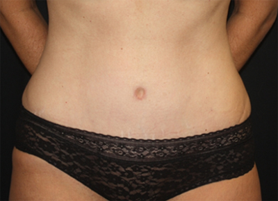 Tummy Tuck Before & After Patient #19963