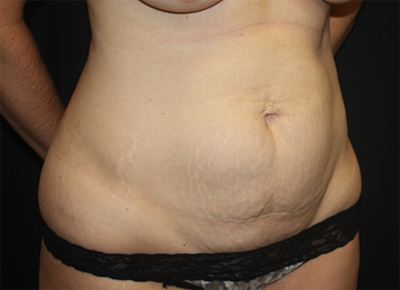 Tummy Tuck Before & After Patient #19963