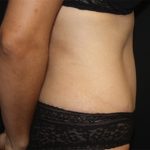 Tummy Tuck Before & After Patient #19963