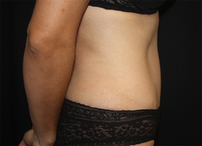 Tummy Tuck Before & After Patient #19963