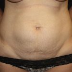 Tummy Tuck Before & After Patient #19963