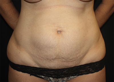 Tummy Tuck Before & After Patient #19963