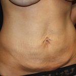 Tummy Tuck Before & After Patient #19974