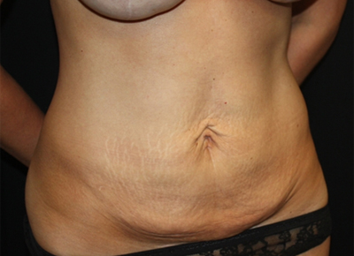 Tummy Tuck Before & After Patient #19974