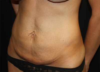 Tummy Tuck Before & After Patient #19974