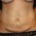 Tummy Tuck Before & After Patient #19974