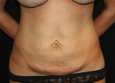 Tummy Tuck Before & After Patient #19974