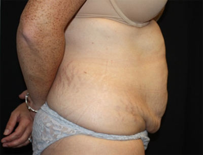 Tummy Tuck Before & After Patient #22618