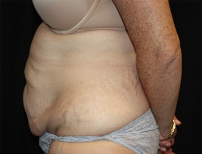 Tummy Tuck Before & After Patient #22618